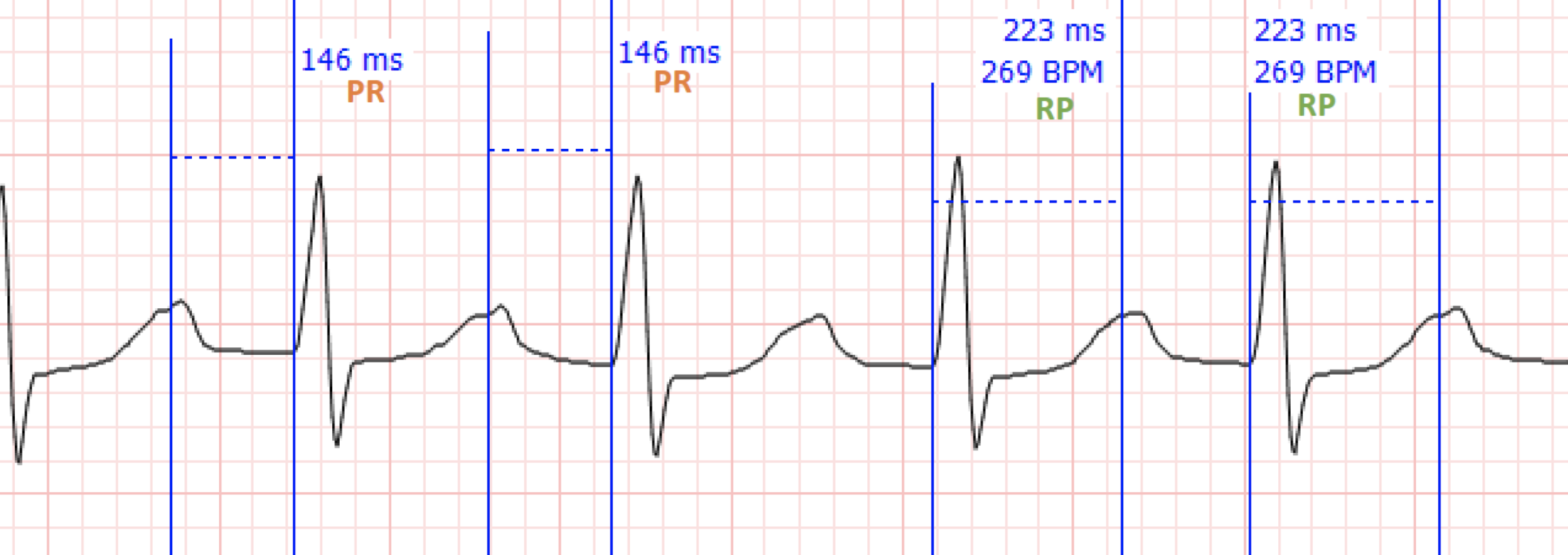 Heart of the Matter: SVT and the RP Interval — Cook County